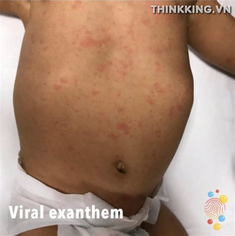 Viral Exanthem Rash: Diagnosis, Symptoms, Causes & Treatment - thinkKING