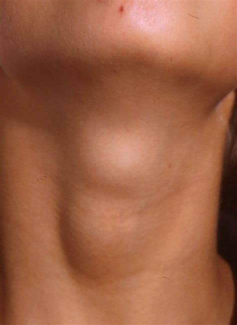 Causes and Treatments of Lumps: Neck, Armpit, Wrist, & More - YouMeMindBody