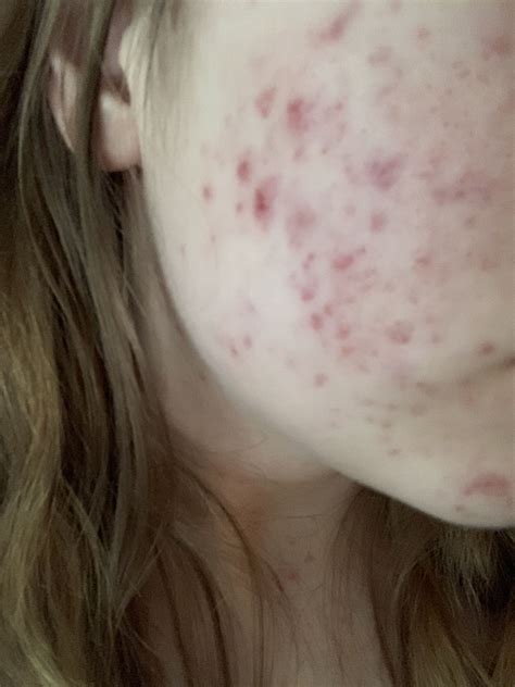 Red marks left over from acne. Any suggestions? – Hyperpigmentation ...