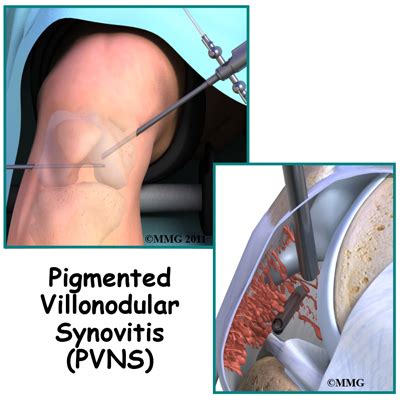 Pigmented Villonodular Synovitis of the Knee | eOrthopod.com