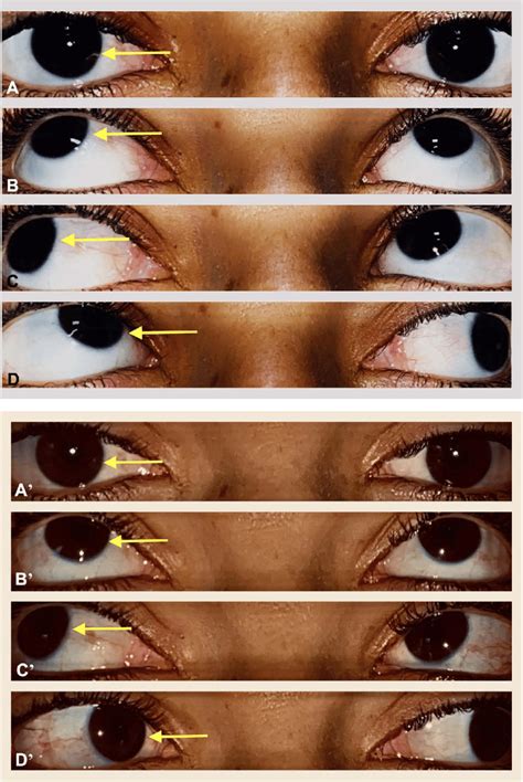 (A) In a first patient with an intermittent divergent squint and 3+... | Download Scientific Diagram