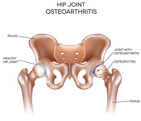 Osteoarthritis of the Hip - How Chiropractic May Help - Bradford House Chiropractic Clinic