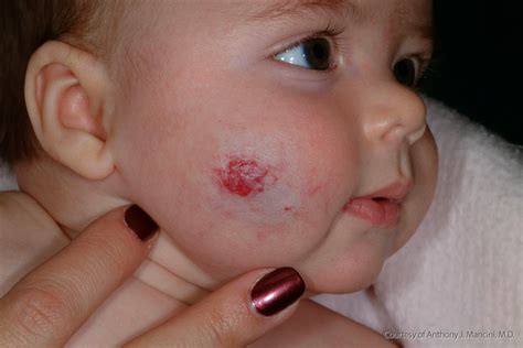 Hemangioma Causes, Identification and Diagnosis | Wiki Itchy Mind