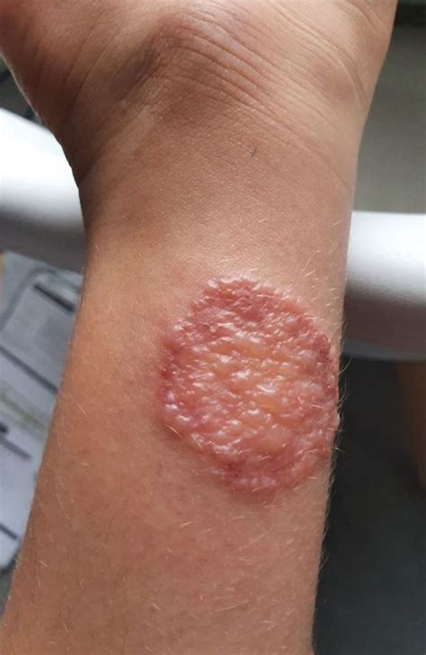 Shocking 'giant hogweed' blister Solihull mum wants you to see after daughter stung on walk ...