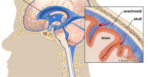 Ohio State's Urban Meyer has one, so what is an arachnoid cyst?