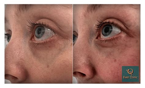 Periorbital/Under Eye Vein Surgery Glasgow, Scotland