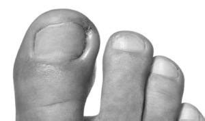 ingrown toenail 2nd page | Foot & Podiatry Surgery