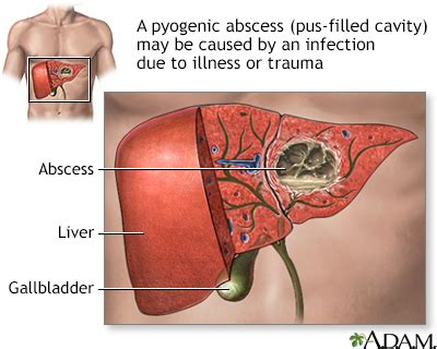 Pyogenic Liver Abscess Symptoms, Doctors, Treatments, Advances & More ...