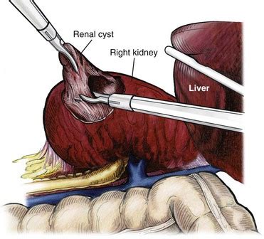 Laparoscopic Surgery of the Kidney | Abdominal Key