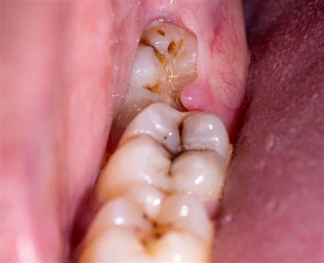 What Does Dry Socket Look Like After Wisdom Tooth Extraction