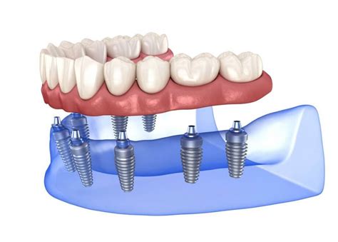 What Are the Different Types of Dental Implants? | Germantown, MD