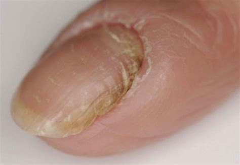 Hangnail & infected hangnail causes, symptoms, diagnosis & treatment