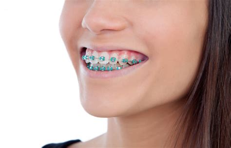 Popular Braces Colors for Girls and Boys - Is black a good braces color?