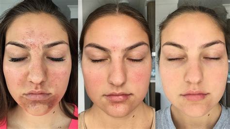 My Accutane Experience + How I Got Clear Skin (Before + After Pictures ...