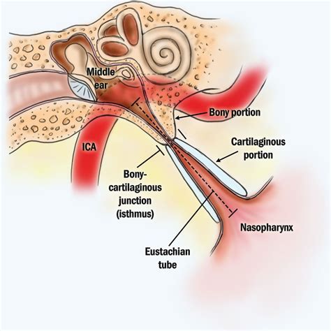 Eustachian Tube Dysfunction - Easmed