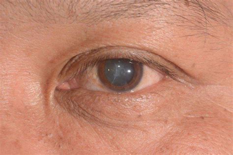 Cataracts - Symptoms, Causes & Treatment | Lions Eye Institute