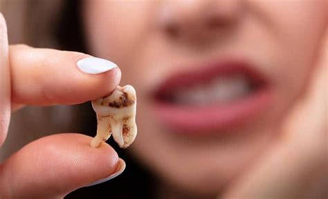 What to know about rotten teeth