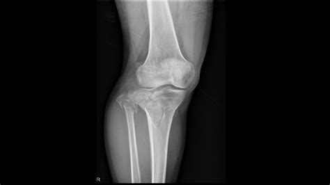 Tibial plateau fracture - wikidoc