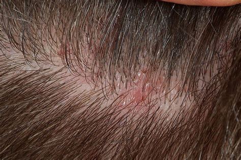 Frontal Fibrosing Alopecia and Lichen Planus Pilare: Diagnosis, Symptoms, and Treatment