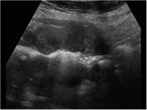 Colon carcinoma longitudinal | Ultrasound, Colon, Sonography