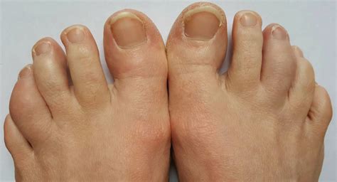 Case Report: A Psoriatic Arthritis Patient with Dactylitis & Enthesitis ...