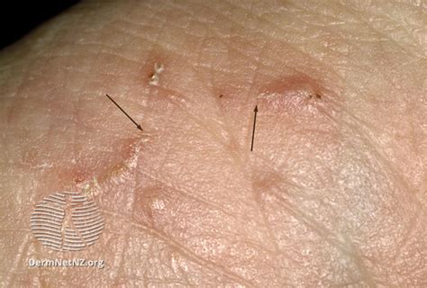 Scabies - The London Skin And Hair Clinic