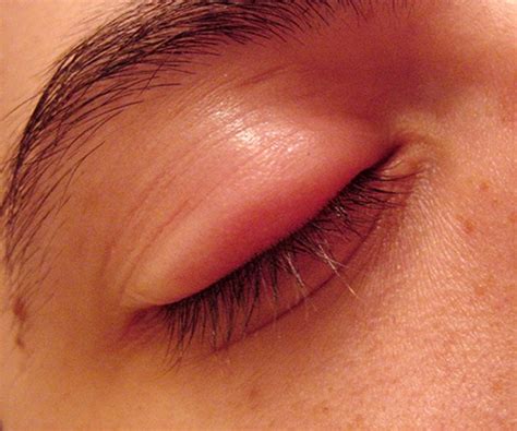 Swollen Eyelid - Symptoms, Treatment, Pictures, Causes | HubPages