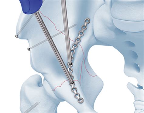 Top Pelvi-acetabular Surgeon | Treatment & Surgery in Jaipur, India