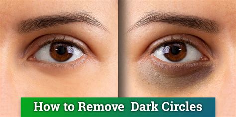Remedies to remove dark circles under eyes - crazzy crafting