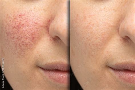 Before and after laser treatment for rosacea Stock Photo | Adobe Stock