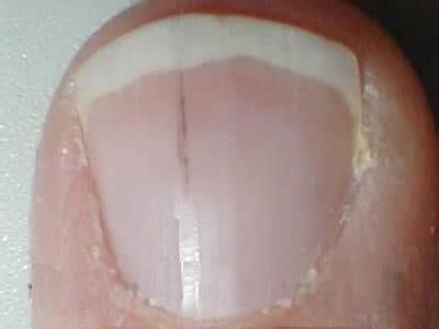 Splinter Fingernails - Curious symptom caused by a blow or possibly an indication of heart ...