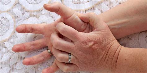 Thumb Arthritis: Symptoms, Treatments, and Prevention Techniques