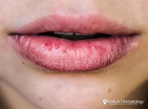 Why are my Lips Always Chapped? - Walk-in Dermatology