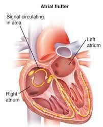 Deciphering Atrial Tachycardia: Causes, Symptoms, and Solutions