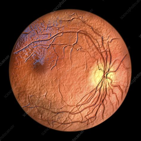 Healthy retina, - Stock Image - F036/4333 - Science Photo Library