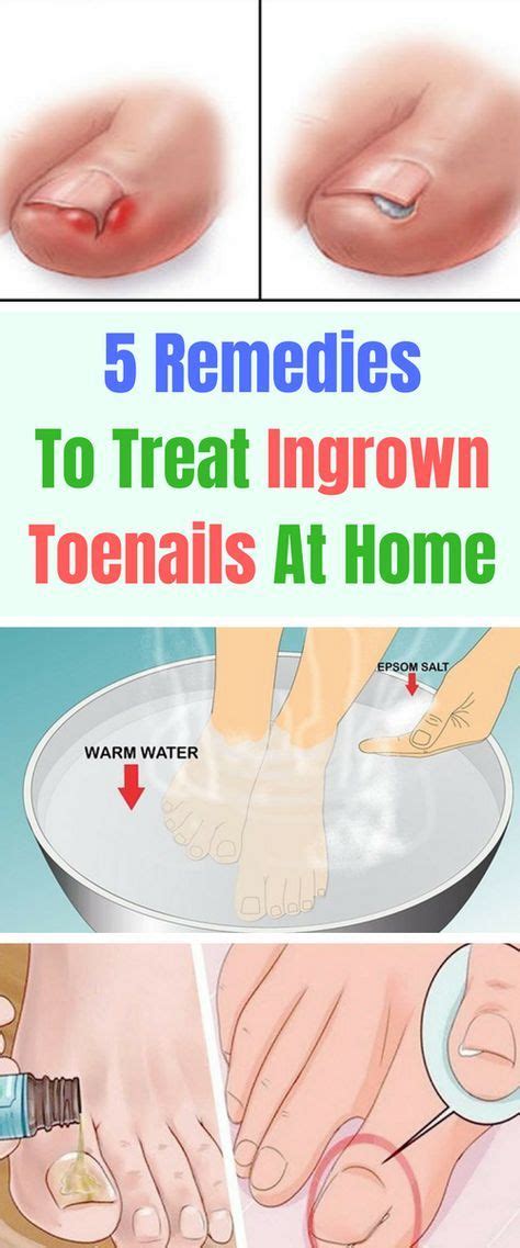 5 Remedies To Treat Ingrown Toenails At Home | Ingrown toe nail