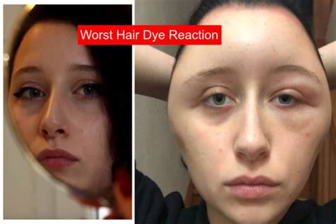 Girl’s head nearly ‘doubles in size’ after allergic reaction to this hair dye – Stackumbrella