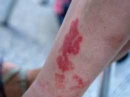 Golfer's Vasculitis (Disney Rash): Causes, Symptoms & More