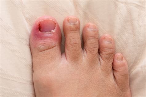 Ingrown Toe Nails - Andover Podiatry Clinic