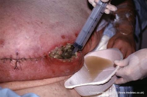 Infected Abdominal Wound