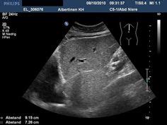 Strawberry Radiological sign Strawberry gallbladder Strawberry gallbladder refers to the surface ...