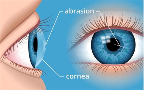 Cornea & external eye diseases unit – Eye Care Center