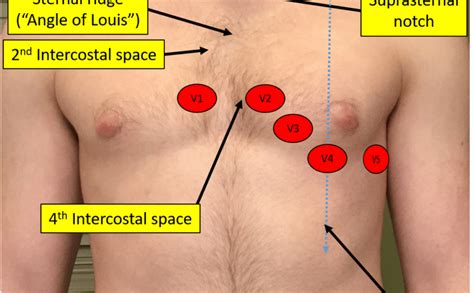 Proper Electrocardiogram (ECG/EKG) Lead Placement