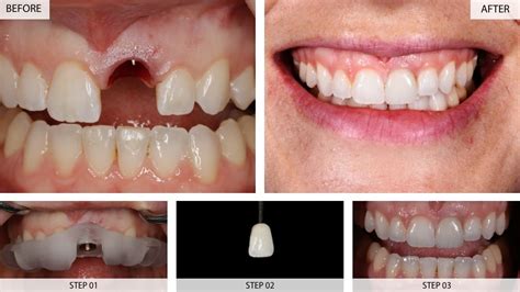 Dental Implants Results (Before & After) - 22 Cases