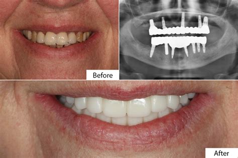 Before And After All-On-4 Dental Implants Pictures | Dental Partners of ...