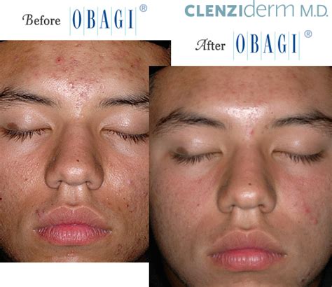 Obagi® Before and After Pictures – Micki Ly M.D. Maui Dermatologist