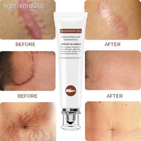 (COD)VG Scar Remover Acne Cream Scars Repair Stretch Marks Pregnancy ...