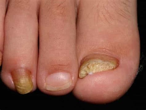 Tinea Unguium Symptoms, Causes And Treatment | Health Feature