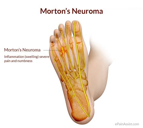 Morton's Neuroma Foot Pain Causes & Treatments | Elite Podiatry