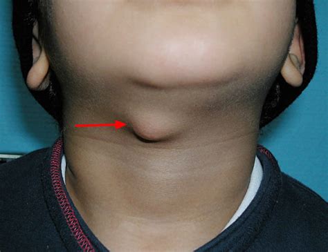 Thyroglossal duct cyst causes, symptoms, diagnosis, treatment & surgery